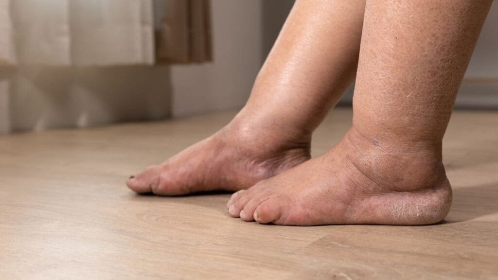 Coração Inchado: Quais os Sintomas? Saiba Tudo Sobre os Sinais de Alerta e Como Prevenir 2 Peis Inchados
